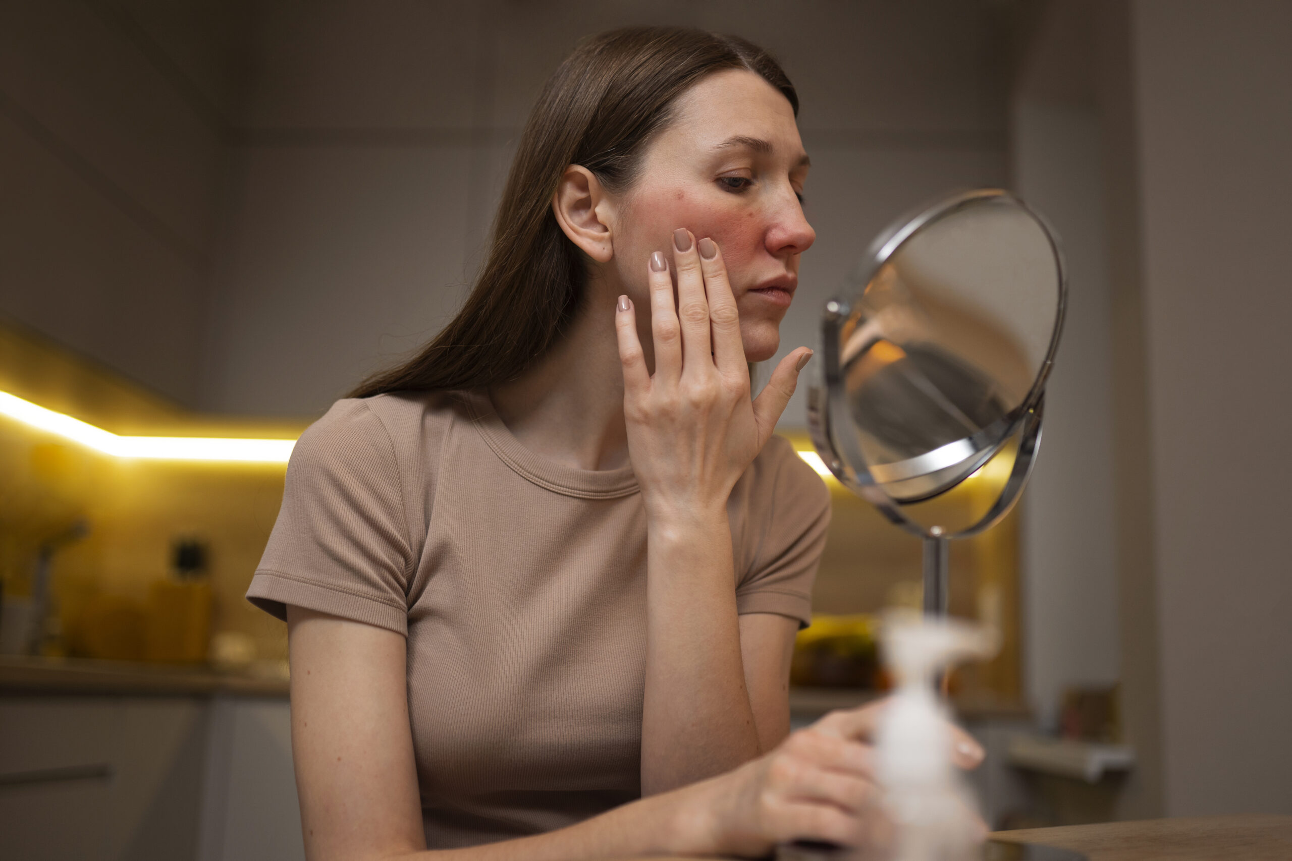 rosacea
