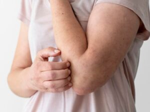 Dermatite Herpetiforme