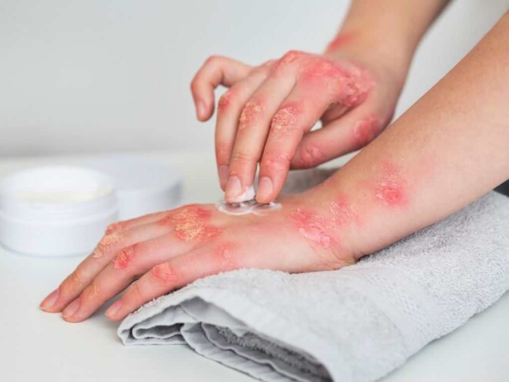 tipos de alergias bolhas