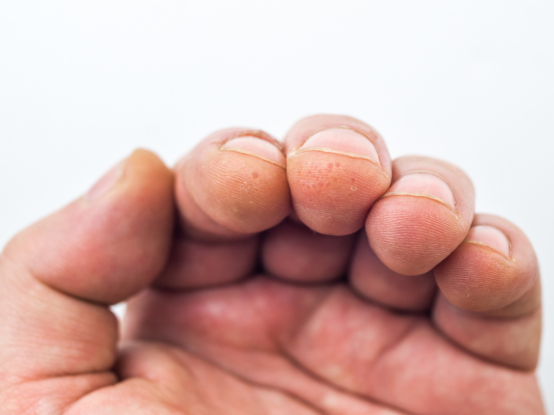 eczema disidrótico disidrose