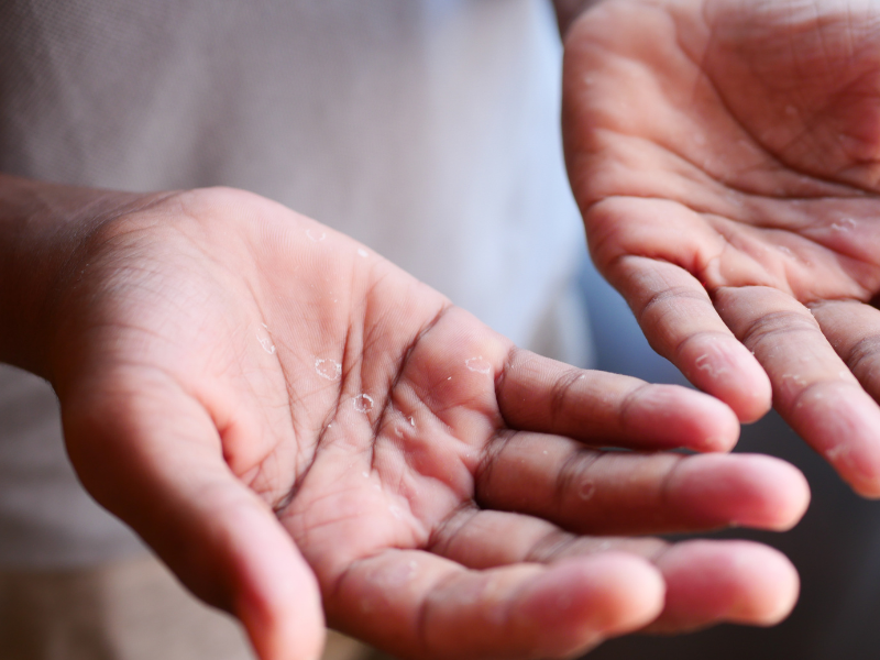 eczema disidrótico mãos