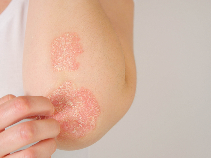 eczema disidrótico psoríase