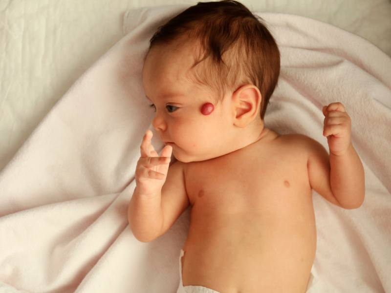 hemangioma infantil  bebê