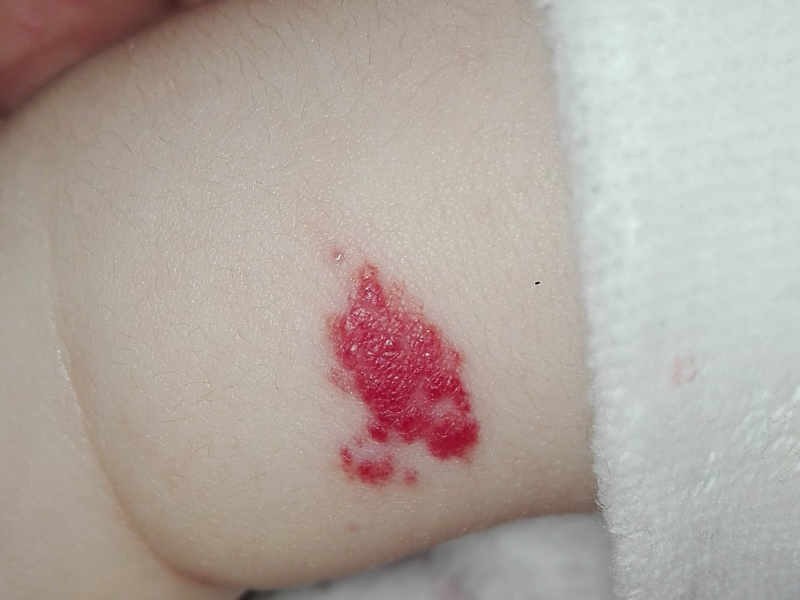 hemangioma infantil pele