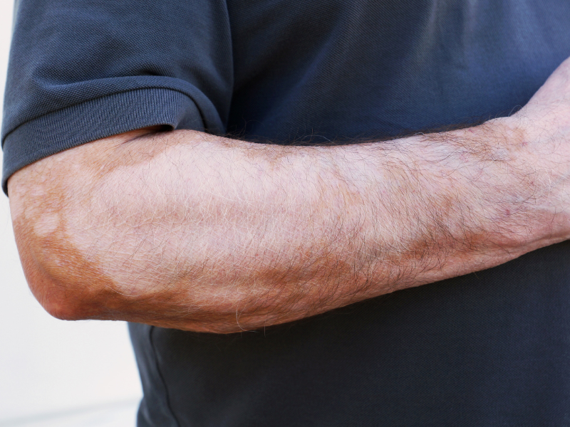 sintomas de vitiligo autoimune
