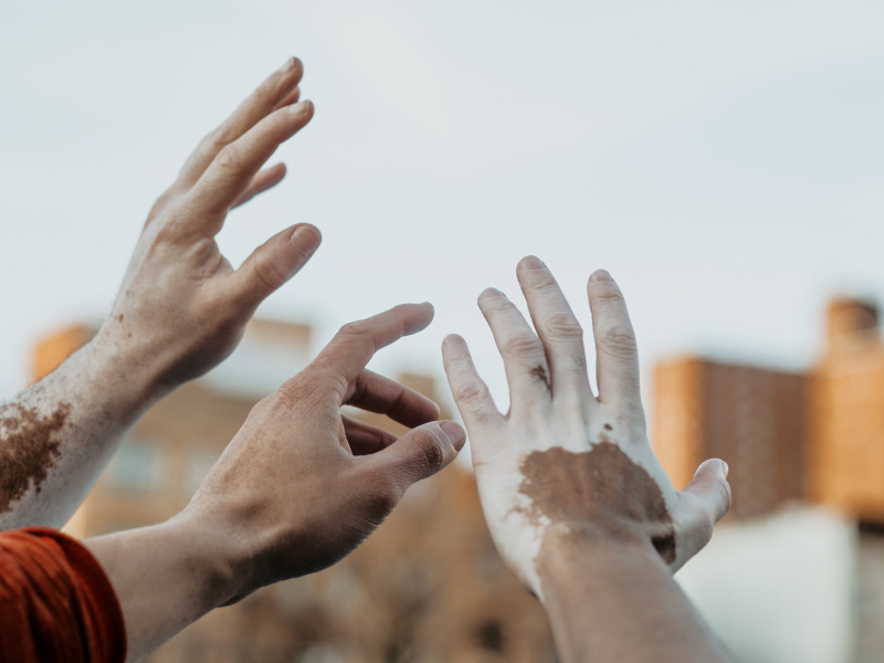 sintomas de vitiligo condição