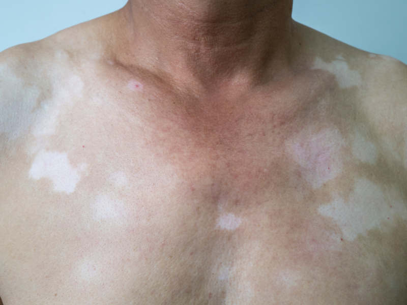 sintomas de vitiligo pele