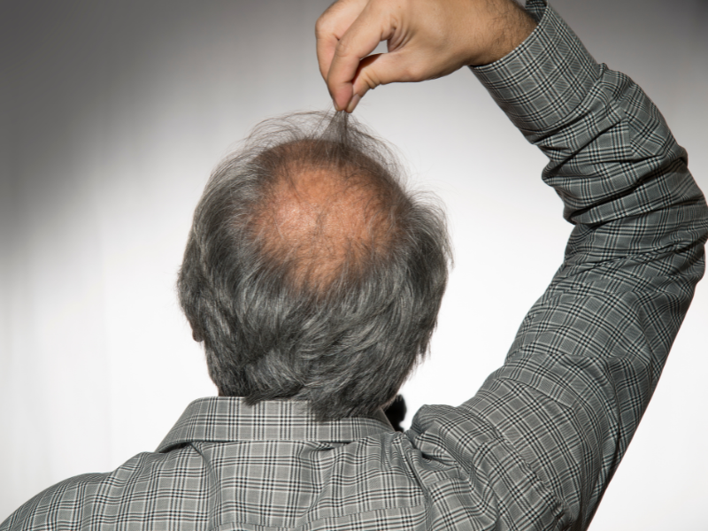 alopecia androgenética