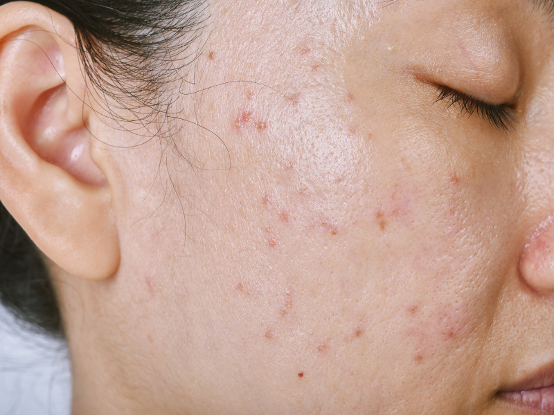 tratamento para pele oleosa acne