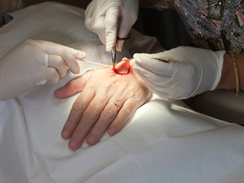 tratamentos para melanoma tipos