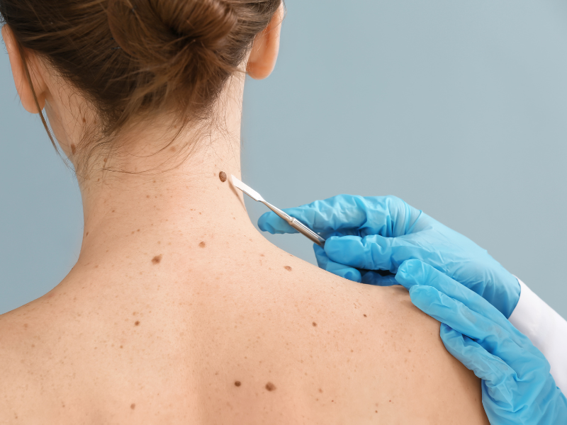 tratamentos para melanoma cuidados