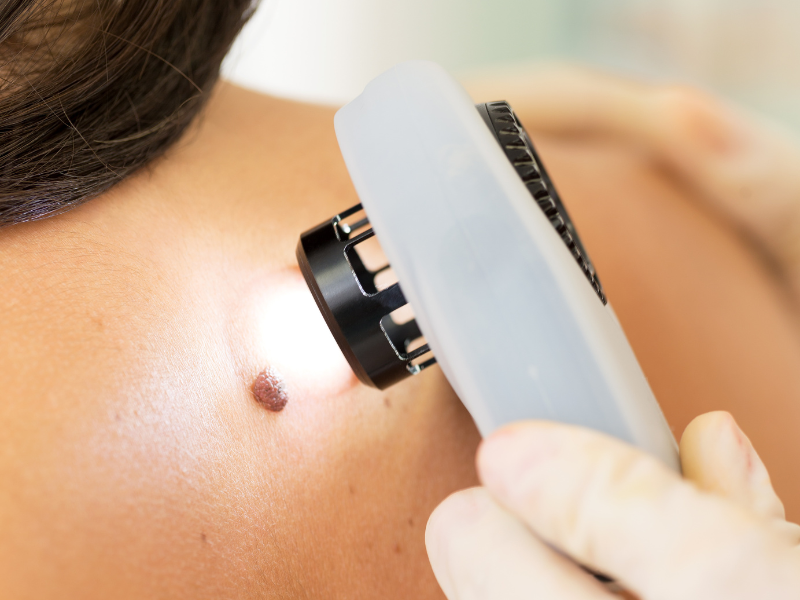 tratamentos para melanoma pele