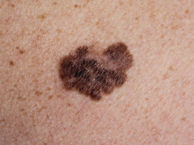 tratamentos para melanoma tipos