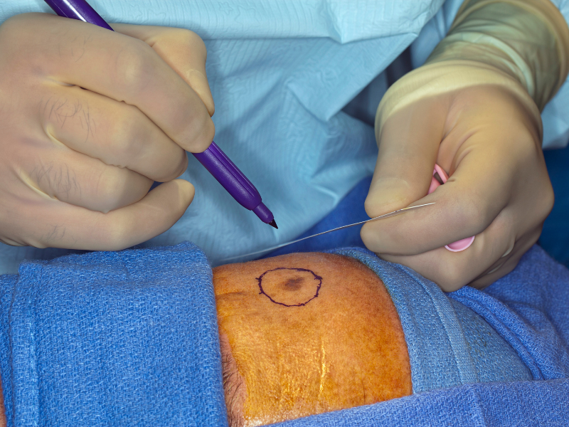 tratamentos para melanoma